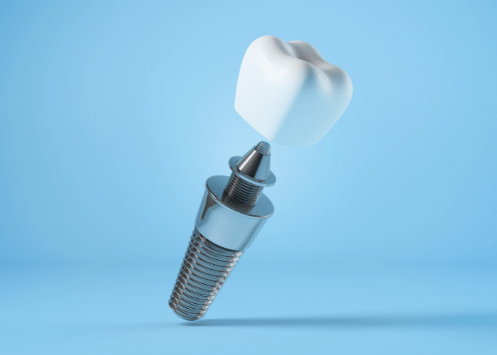 An image of a dental implant